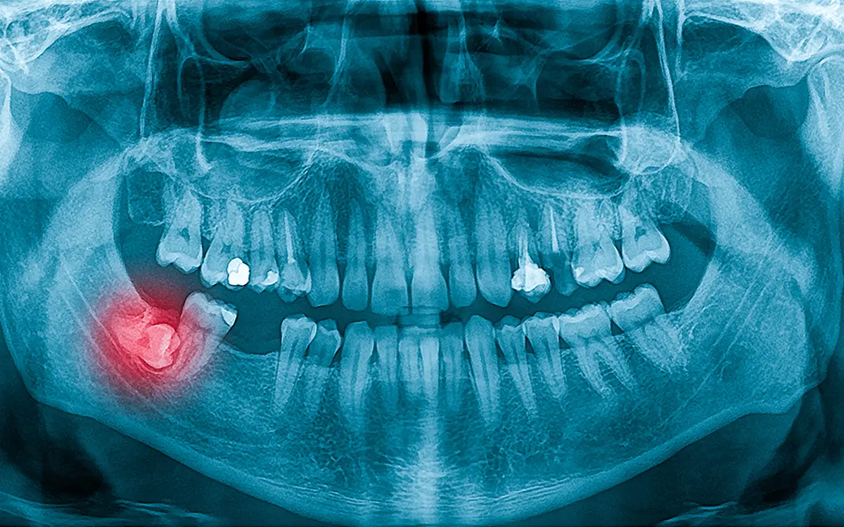 20’lik dişler, 17-25 yaş arasında çıkan ve ağzın en arka kısmında bulunan üçüncü azı dişleridir. Genellikle ağız yapısında yeterli alan olmadığından, bu dişler gömülü kalabilir veya yanlış açıda çıkabilir. Bu durum; ağrı, şişlik, enfeksiyon ve komşu dişlerde çürük gibi problemlere yol açar. 20’lik diş çekimi, bu komplikasyonları önlemek veya mevcut sorunları çözmek için uygulanan cerrahi bir işlemdir.