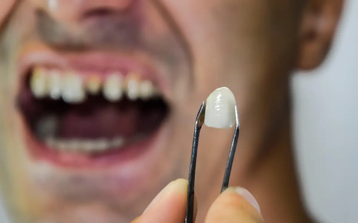 Bonding, dişlerin doğal görünümünü iyileştirmek için kullanılan minimal invaziv bir estetik diş hekimliği yöntemidir. Diş yüzeyine özel bir kompozit reçine materyali uygulanarak dişlerdeki kırık, çatlak, boşluk veya renk değişiklikleri düzeltilir. Hızlı ve ağrısız bir işlem olan bonding, gülüş tasarımı için etkili bir çözümdür.