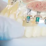 Cerrahi implant, kaybedilen dişlerin yerine çene kemiğine yerleştirilen titanyum vidalardır. Diş eksikliklerini kalıcı ve estetik bir şekilde gidermek için uygulanır. Tek diş eksikliği, çoklu diş kayıpları veya tam dişsiz ağızlar için idealdir. Diş implantı, doğal diş görünümüne ve fonksiyonuna en yakın çözümdür.