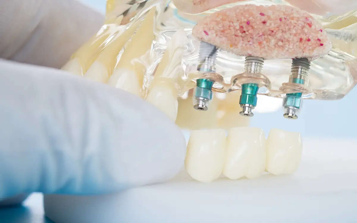 Cerrahi implant, kaybedilen dişlerin yerine çene kemiğine yerleştirilen titanyum vidalardır. Diş eksikliklerini kalıcı ve estetik bir şekilde gidermek için uygulanır. Tek diş eksikliği, çoklu diş kayıpları veya tam dişsiz ağızlar için idealdir. Diş implantı, doğal diş görünümüne ve fonksiyonuna en yakın çözümdür.