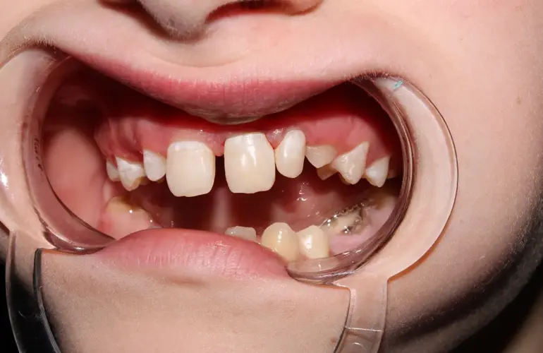 Diastema, dişler arasındaki boşlukları ifade eder ve estetik ya da fonksiyonel sorunlara neden olabilir. Diastema kapama tedavisi, bu boşlukları doldurarak daha düzenli ve estetik bir diş görünümü sağlar. Estetik diş hekimliği yöntemleriyle uygulanan bu tedavi, sağlıklı bir ağız yapısına kavuşmanızı da destekler.
