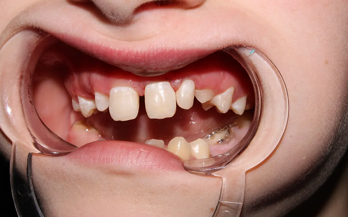 Diastema, dişler arasındaki boşlukları ifade eder ve estetik ya da fonksiyonel sorunlara neden olabilir. Diastema kapama tedavisi, bu boşlukları doldurarak daha düzenli ve estetik bir diş görünümü sağlar. Estetik diş hekimliği yöntemleriyle uygulanan bu tedavi, sağlıklı bir ağız yapısına kavuşmanızı da destekler.