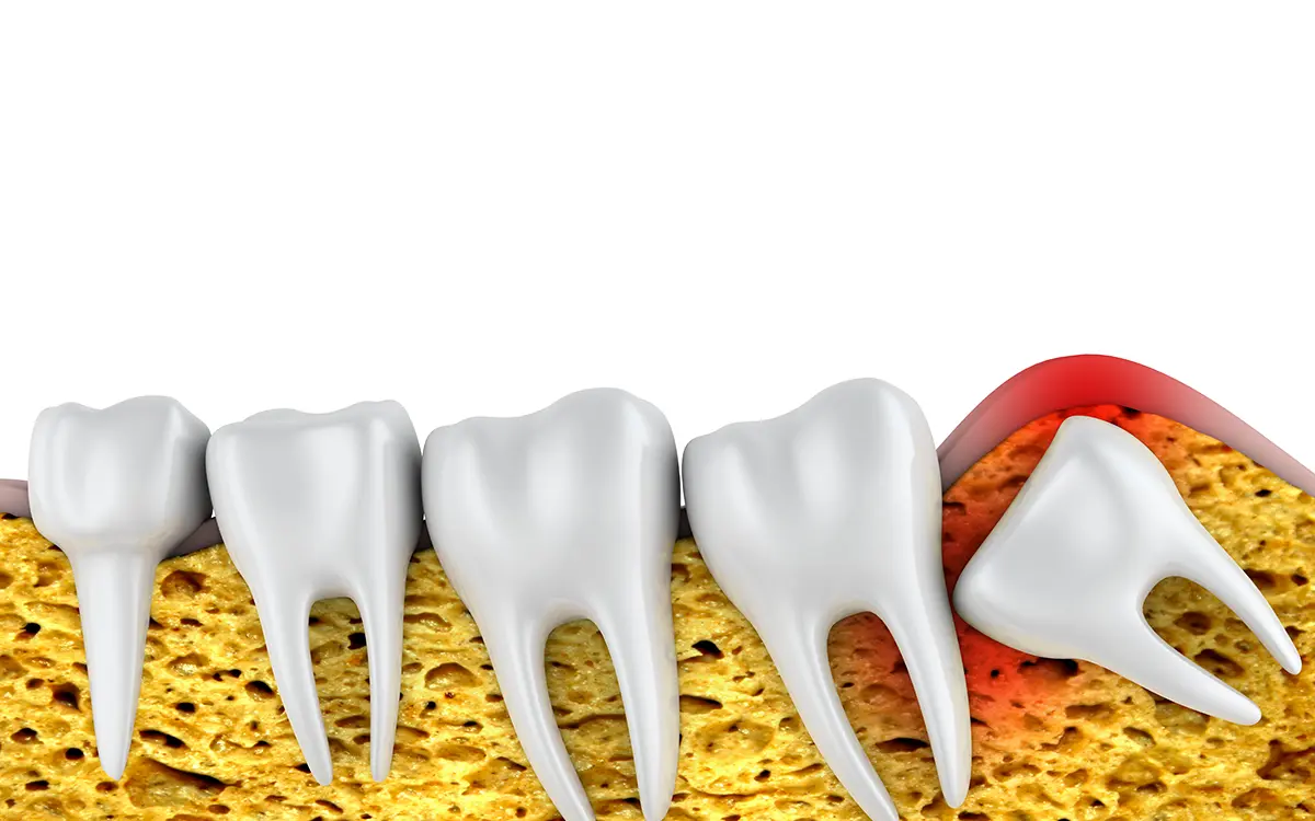 Gömülü dişler, çene kemiği veya diş eti altında tam olarak çıkamayan dişlerdir. Çoğunlukla 20’lik dişler olarak bilinen üçüncü azı dişleri bu kategoriye girer. Dişin çıkması için yeterli yer olmadığında veya yanlış konumlandığında gömülü kalır ve zamanla ağrı, şişlik ve enfeksiyon gibi sorunlara neden olabilir.