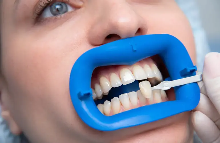 Porselen Laminate Veneer, dişlerin ön yüzeyine ince porselen tabakaların yapıştırılmasıyla uygulanan bir estetik diş hekimliği tedavisidir. Bu yöntem, dişlerin rengini, şeklini ve boyutunu iyileştirmek için ideal bir seçenektir. Doğal diş yapınızı koruyarak kusursuz bir gülüş elde etmenizi sağlar.