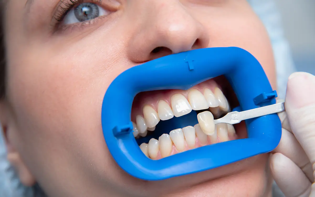 Porselen Laminate Veneer, dişlerin ön yüzeyine ince porselen tabakaların yapıştırılmasıyla uygulanan bir estetik diş hekimliği tedavisidir. Bu yöntem, dişlerin rengini, şeklini ve boyutunu iyileştirmek için ideal bir seçenektir. Doğal diş yapınızı koruyarak kusursuz bir gülüş elde etmenizi sağlar.