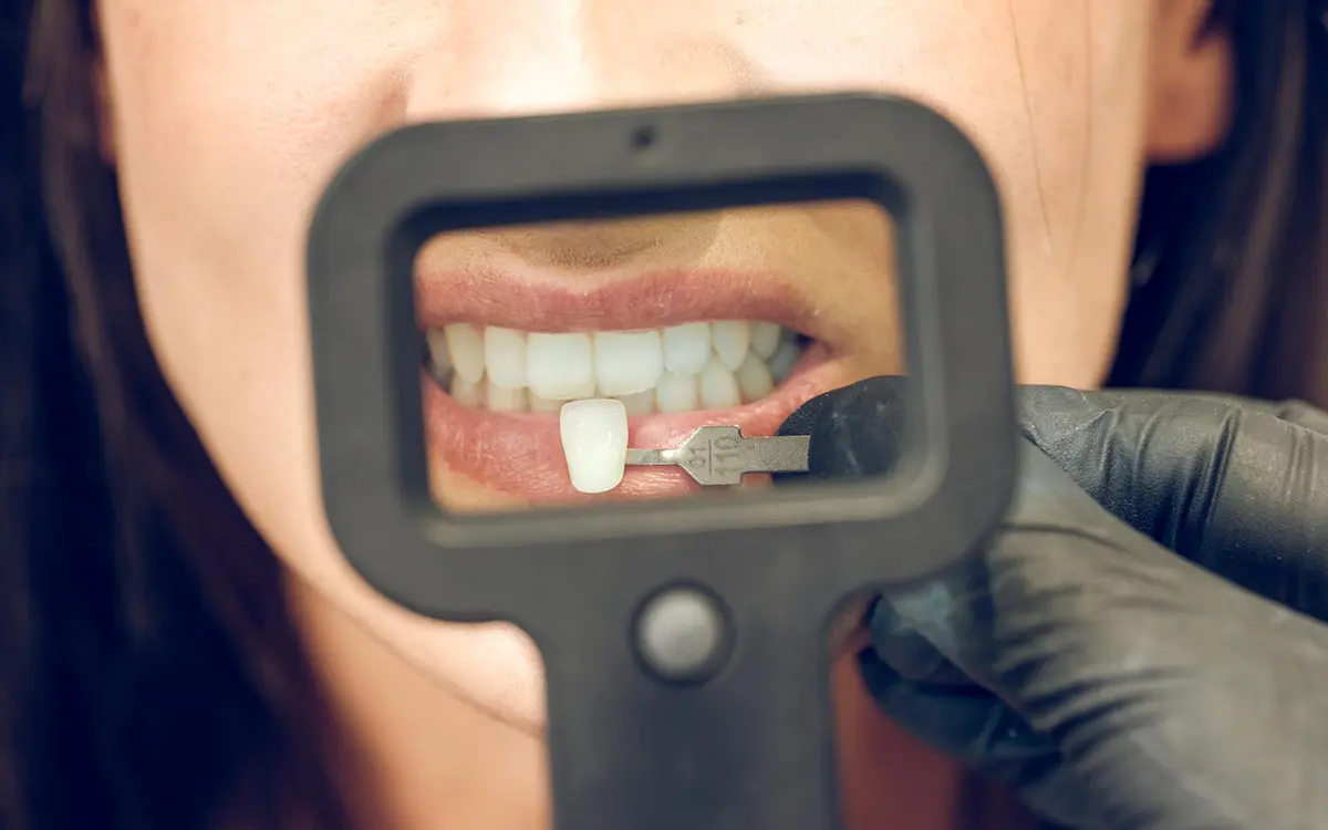 Zirkonyum restorasyonlar, diş kaybı, çürük veya estetik ihtiyaçlar nedeniyle dişlerin kaplanması için kullanılan dayanıklı, biyouyumlu ve estetik bir tedavi yöntemidir. Metal destekli kaplamaların aksine, zirkonyum kaplamalar doğal diş rengini mükemmel bir şekilde taklit eder ve sağlıklı bir ağız yapısı sağlar.